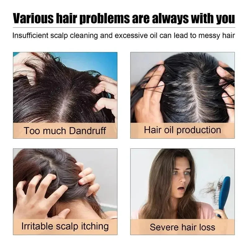 Fast Anti Dandruff Hair Treatment Soap Itching Repair Scalp Cleaning Exfoliating Products Oil Control Antipruritic Hair Care