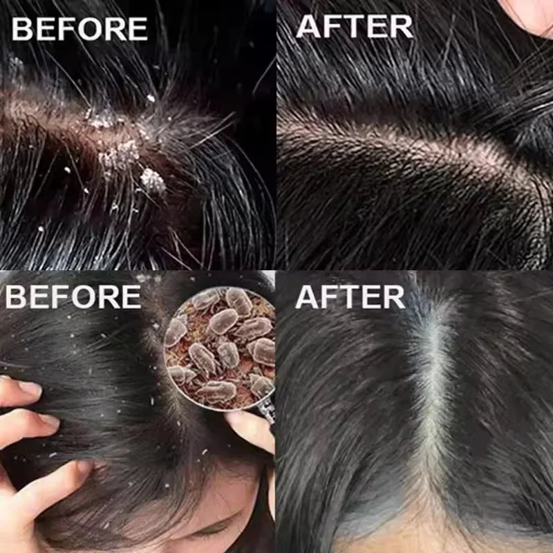 Fast Anti Dandruff Hair Treatment Soap Itching Repair Scalp Cleaning Exfoliating Products Oil Control Antipruritic Hair Care