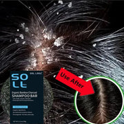 Fast Anti Dandruff Hair Treatment Soap Itching Repair Scalp Cleaning Exfoliating Products Oil Control Antipruritic Hair Care