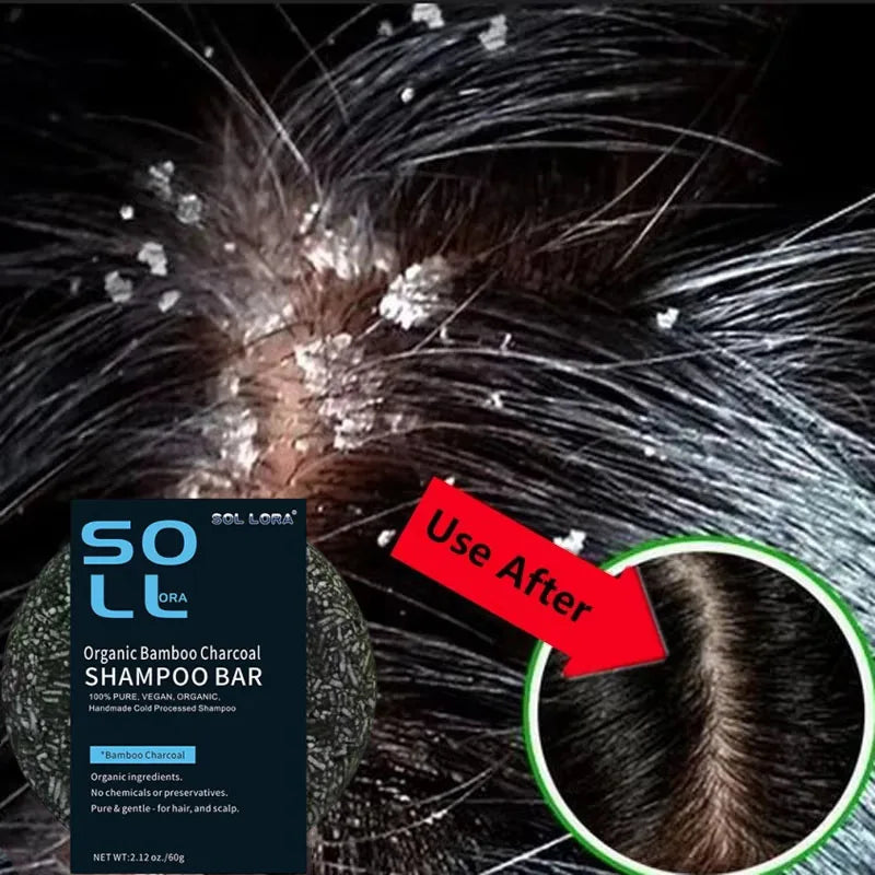 Fast Anti Dandruff Hair Treatment Soap Itching Repair Scalp Cleaning Exfoliating Products Oil Control Antipruritic Hair Care