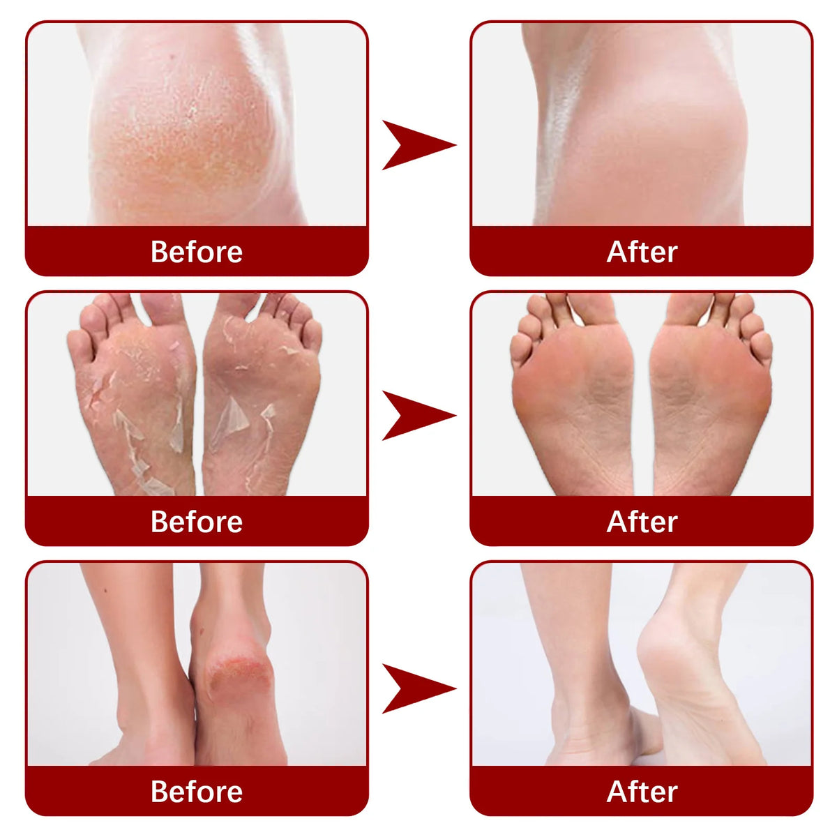 Exfoliating Feet Mask Sock Exfoliation Scrub for Feet Mask Remove Dead Skin Moisturizing Pedicure Anti Crack Foot Patch Spa 5PCS