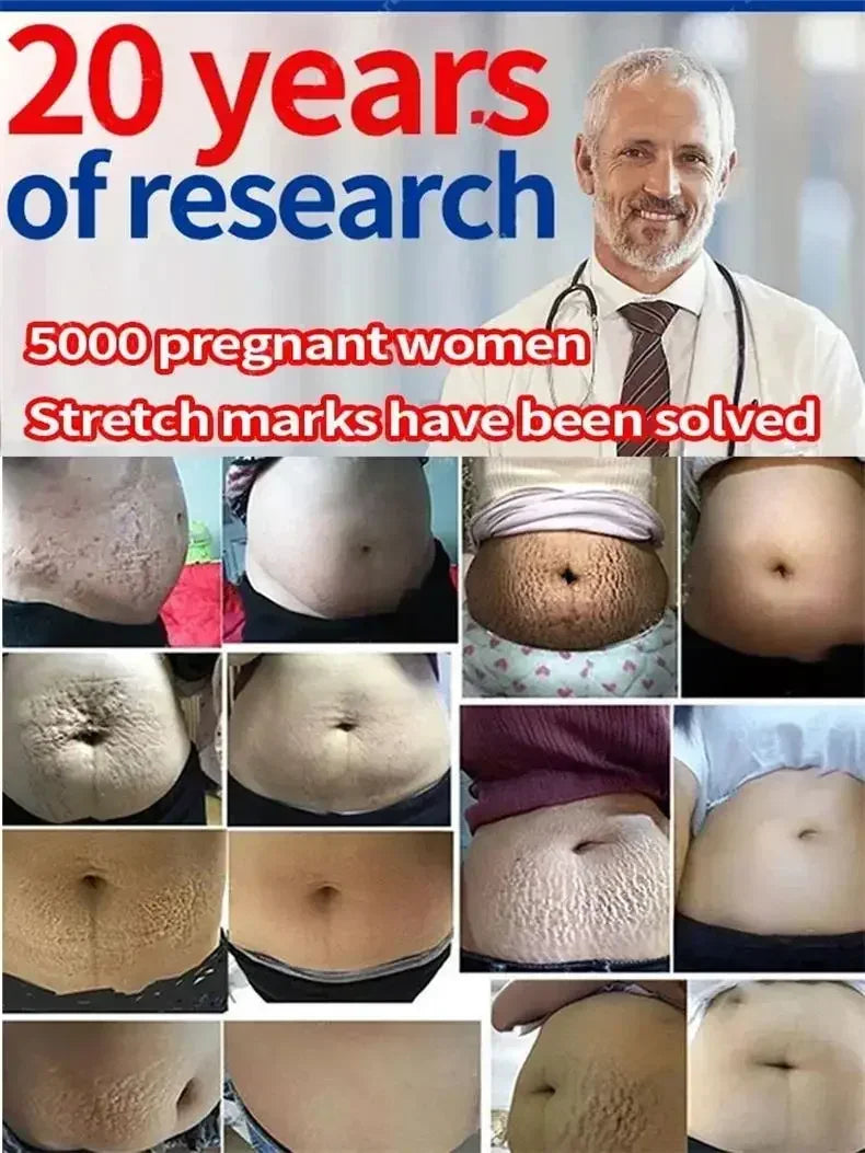 Stretch Marks Removal Cream Light Lines Postpartum Obesity Pregnancy Powerful Fast Absorption