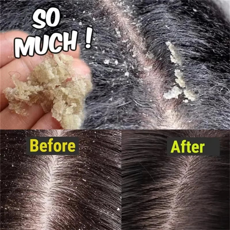 Fast Anti Dandruff Hair Treatment Soap Itching Repair Scalp Cleaning Exfoliating Products Oil Control Antipruritic Hair Care