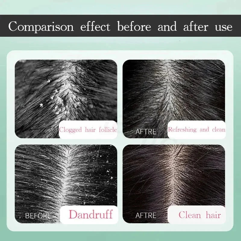 Fast Anti Dandruff Hair Treatment Soap Itching Repair Scalp Cleaning Exfoliating Products Oil Control Antipruritic Hair Care