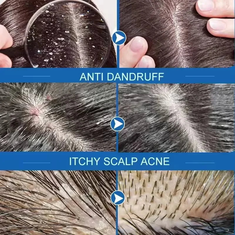 Fast Anti Dandruff Hair Treatment Soap Itching Repair Scalp Cleaning Exfoliating Products Oil Control Antipruritic Hair Care