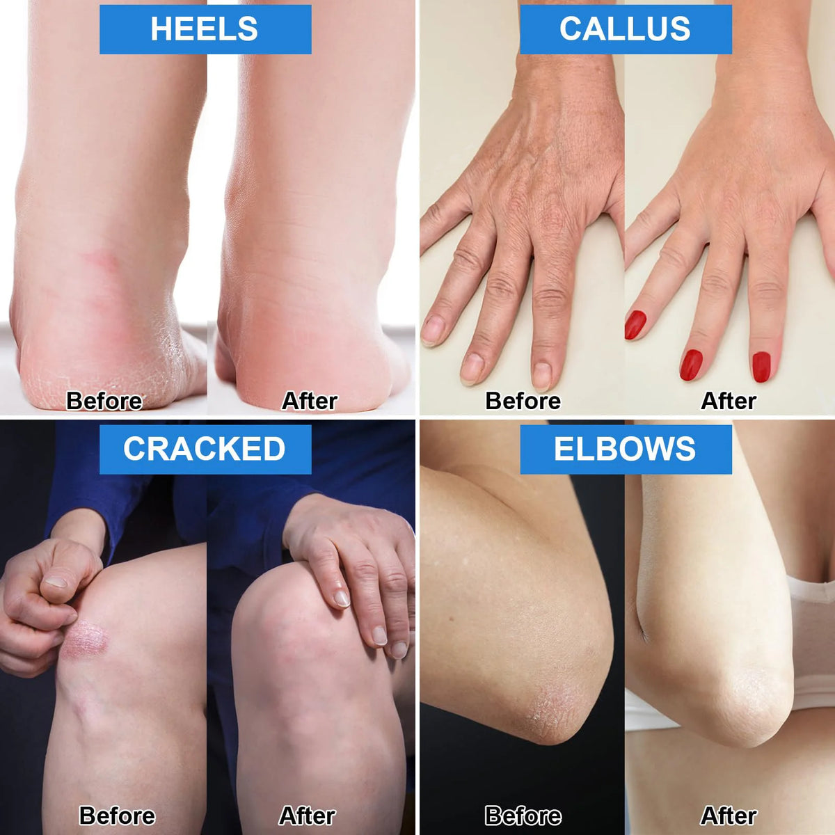 Urea Cream 42% Plus Salicylic Acid 2%, Lavender Foot Cream for Dry Cracked Heels Treatment Knees Elbows Hands Repair Treatment,